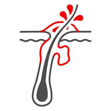 Furuncle thin line icon, Human diseases concept, pustule sign on white Stock Illustration