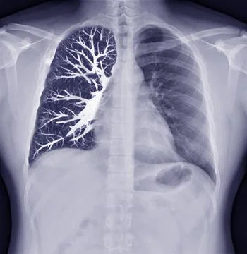 Fusion image of Chest x-ray and CT Chest  Coronal view  for lung infection .. Illustrazione stock