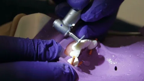 Future Dentist Smoothing Out a Front Tooth Filling Stock Footage 106324270
