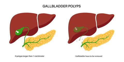Gallbladder anatomy poster Stock Illustration