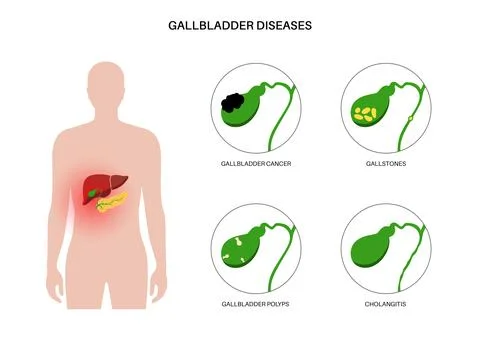 Gallbladder diseases poster Stock Illustration