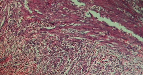 Gallbladder necrosis tissue Stock Footage 145676649
