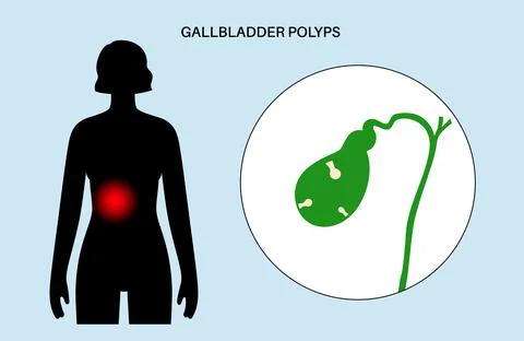 Gallbladder polyp anatomy Stock Illustration
