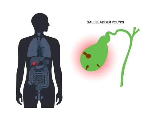 Gallbladder polyp anatomy Stock Illustration