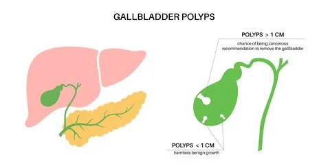 Gallbladder polyp anatomy Stock Illustration