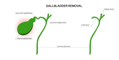 Gallbladder removal surgery Stock Illustration