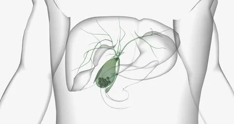 Gallstones are pieces of solid material that form in the gallbladder, a sma.. Stock Illustration