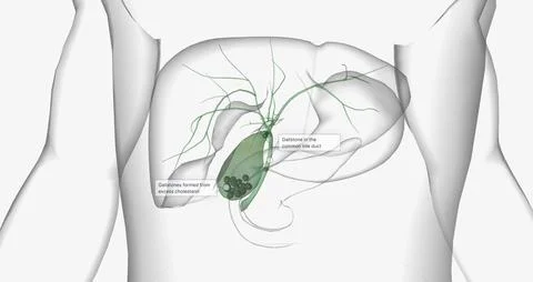 Gallstones are pieces of solid material that form in the gallbladder, a sma.. Stock Illustration