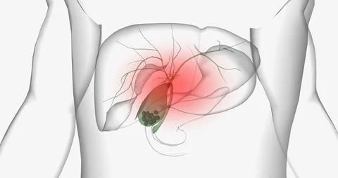 Gallstones are pieces of solid material that form in the gallbladder, a sma.. Stock Illustration