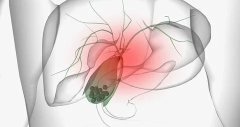 Gallstones are pieces of solid material that form in the gallbladder, a sma.. Stock Illustration