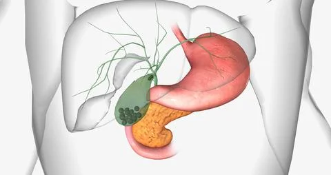 Gallstones are pieces of solid material that form in the gallbladder, a sma.. Illustrazione stock