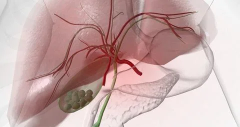 Gallstones are pieces of solid material that form in the gallbladder, a small Stock Illustration