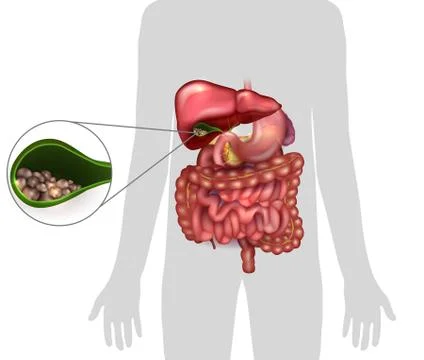Gallstones in the Gallbladder Stock Illustration