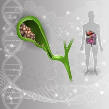 Gallstones in the Gallbladder Stock Illustration