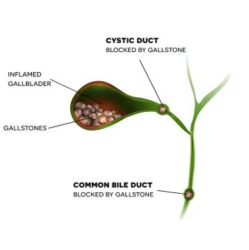 Gallstones in the Gallbladder Illustrazione stock