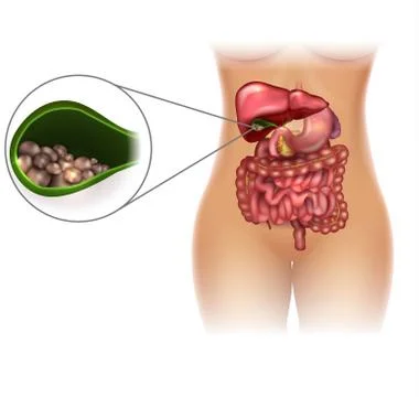 Gallstones in the Gallbladder Stock Illustration
