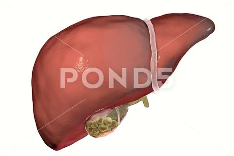 Gallstones, illustration showing front view of liver and gallbladder ...