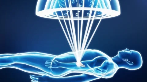 Gamma Knife radiotherapy precisely targets pancreatic tumors 스톡 동영상 345198807