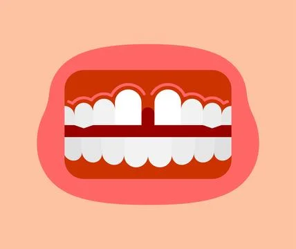 Gap mouth. Large space between teeth. Stock Illustration