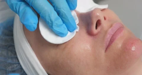 Gas-liquid peeling procedure. close-up of woman's face at the reception at the Stock Footage 159674953