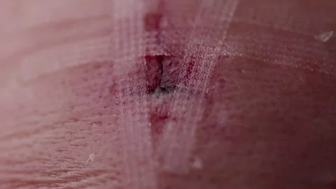 Gash on forehead swelling and bleeding. Head injury close up wound. Stock Footage 294469060