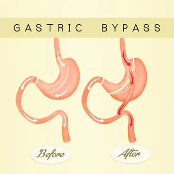 Gastric bypass Stock Illustration
