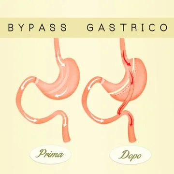 Gastric bypass Stock Illustration