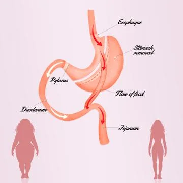 Gastric bypass Stock Illustration