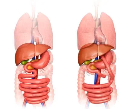Gastric bypass, illustration Stock Illustration