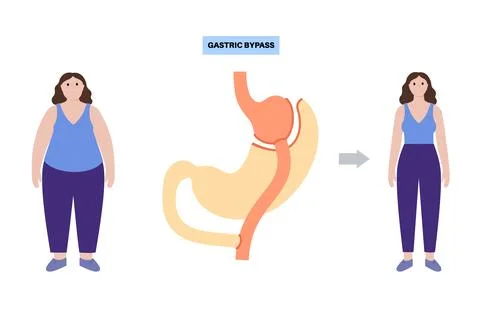 Gastric bypass surgery Stock Illustration