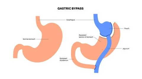 Gastric bypass surgery Stock Illustration