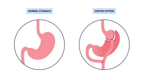 Gastric bypass surgery Stock Illustration