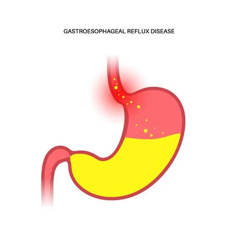 Gastroesophageal reflux disease Stock Illustration