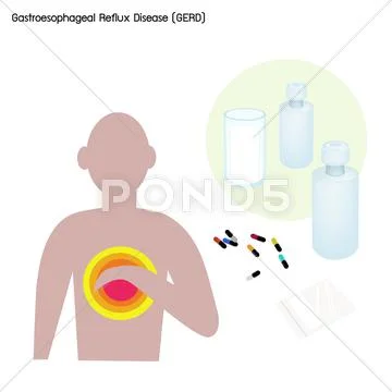 Gastroesophageal Reflux Disease or GERD with Treatment Stock Illustration