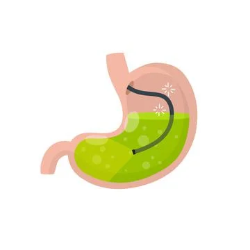 Gastroscopy. Endoscopy and digestive problems. Hose with camera. Illustrazione stock