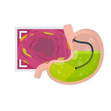 Gastroscopy. Endoscopy and digestive problems. Hose with camera Stock Illustration