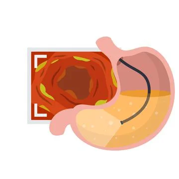Gastroscopy. Endoscopy and digestive problems. Hose with camera イラスト素材