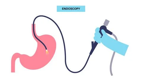 Gastroscopy endoscopy procedure Stock Illustration