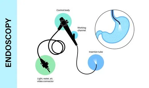 Gastroscopy endoscopy procedure Stock Illustration