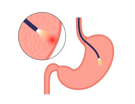 Gastroscopy endoscopy procedure Stock Illustration