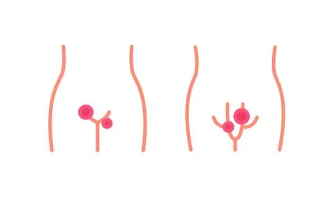 Genital herpes flat icon, vector color illustration Stock Illustration