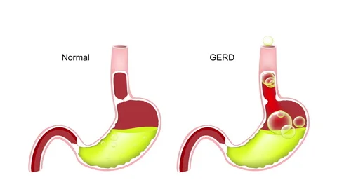 GERD Vidéo 259697023