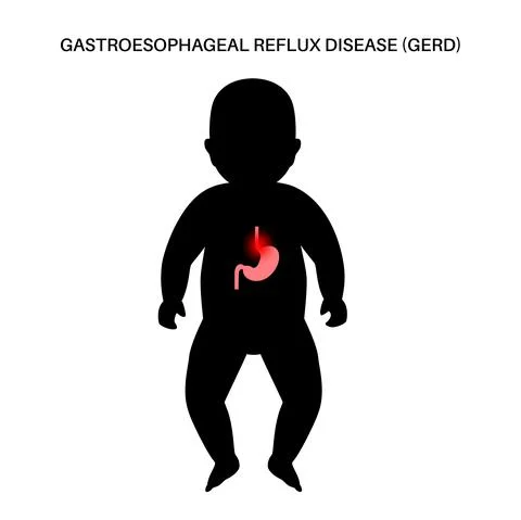 GERD in infant body Stock Illustration