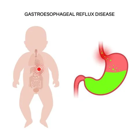 GERD in infant body Illustrazione stock