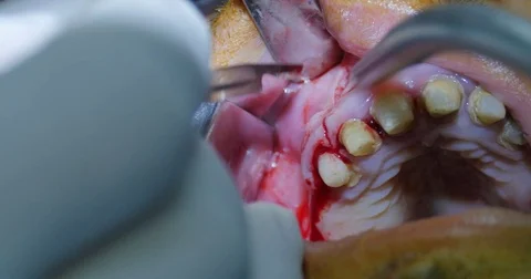 Gingival incision Stock Footage 70172069