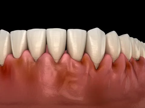 Gingivitis inflammation of the gums. Medically accurate 3D illustration Illustrazione stock