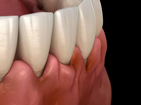 Gingivitis inflammation of the gums. Medically accurate 3D illustration Stock Illustration