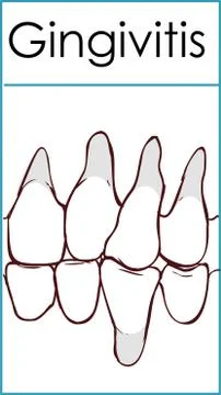 Gingivitis. Inflammation of the gums.  Vector illustration on isolated backgr Stock Illustration