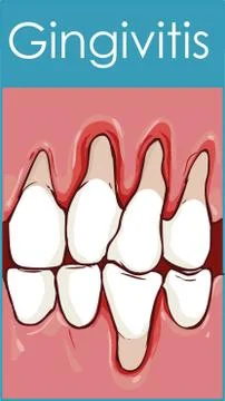 Gingivitis. Inflammation of the gums.  Vector illustration on isolated backgr Stock Illustration