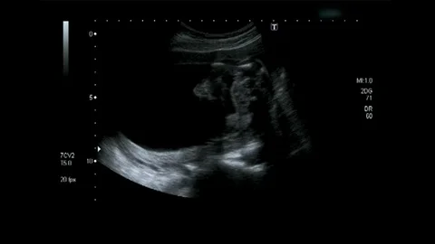 GIO-Ultrasound18-Body Stock Footage